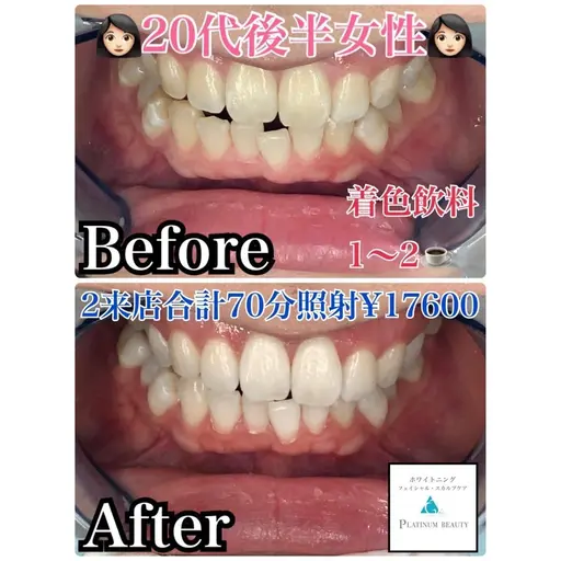 《初回限定》プレミアムセルフホワイトニング★最短で白くなりたい方★2来店コース　合計70分照射