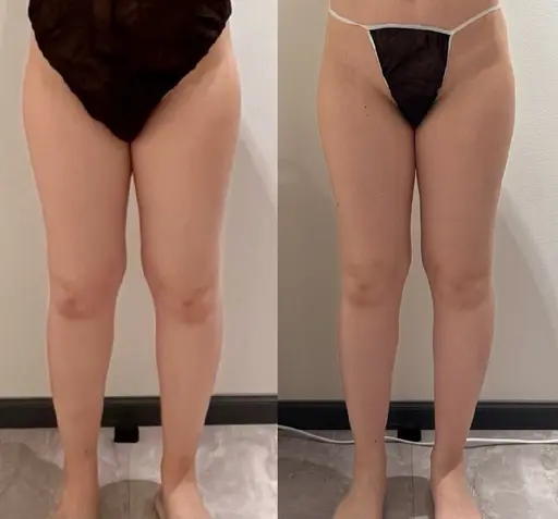 【4/15限定】足痩せ＆セルライト除去 / 施術時間45分 / 1980円