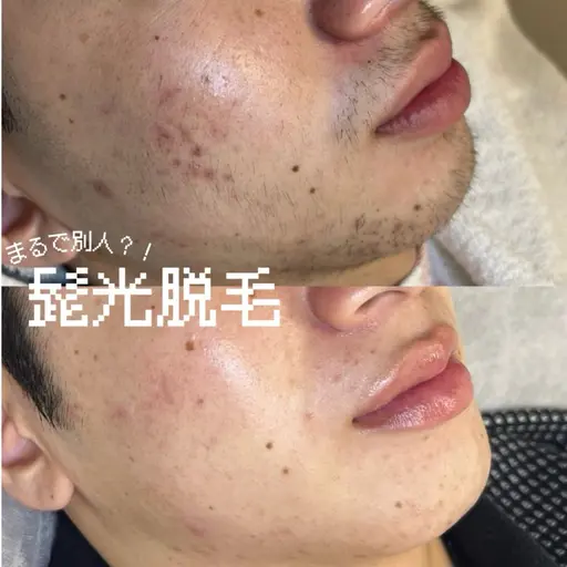 本日❗️3/27(金)【17:00​〜​/18:00​〜​】メンズ/ヒゲ全体光脱毛¥0🧔🏻🔥スキルアップレッスンモデル🆙