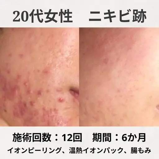 《本日限定》ヘッドマッサージ付き💆🏻‍♀️💖しぶといニキビ跡も◎ピーリング＋温熱パック