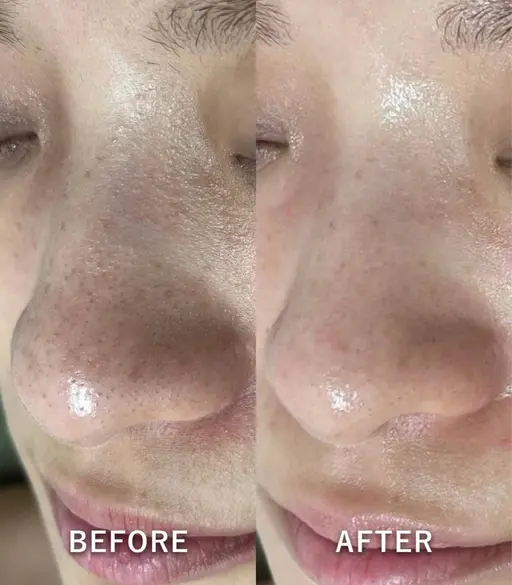 【卒業前の駆け込み肌ケア】ツヤ肌透明感毛穴洗浄フェイシャル¥9,900