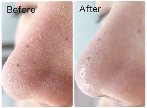 毛穴悩みに◎【3D毛穴洗浄＋高保湿パック付】