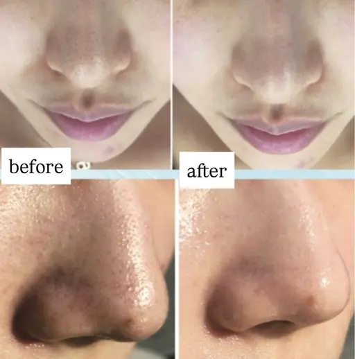 4月末日まで3名限定！お得な3回券《毛穴の黒ずみ改善》ピーリング＋ハイドラ毛穴洗浄＋保湿UPパック