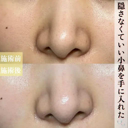 【お試し毛穴洗浄】鼻ハイドラ