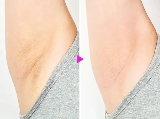 【黒ずみ美白脱毛】脇プラ脱毛2回分