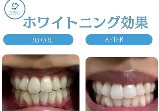 【ミニモ学割1日完結型ホワイトニング歯の黄ばみ1日で解決】ワンデーホワイトニング　歯を1日でスグ白くしたい方オススメ