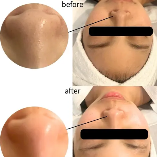 【イベント前🌼集中ケア】ピーリング🌿毛穴洗浄🧹+全身エステ(60分)透明感、小顔、ツヤ、毛穴