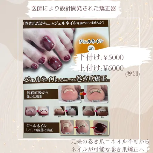 【特別価格30%off🈹痛い巻爪にサヨナラ】両足親指巻き爪矯正＋フットワンカラー