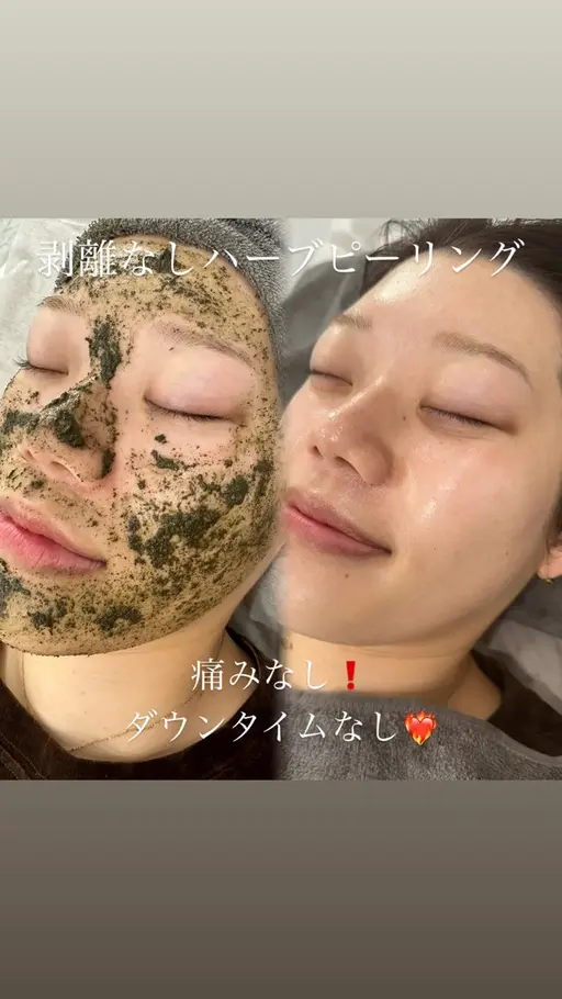 明日🈳有り♡【初回限定価格 】50％OFF‼️剥離なしハーブピーリング🌿ニキビ・毛穴悩みを根本改善🎀
