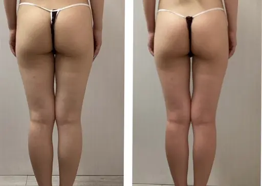 💕【即効】小顔コルギ+【強力】キャビテーション美脚70分💕憧れの小顔＆ヘルシー/スラリ美脚をご一緒に手に入れよう✨