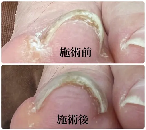フット親指巻き爪矯正練習＋ジェルワンカラー⚠️必ず以下の補足説明をご確認ください⚠️