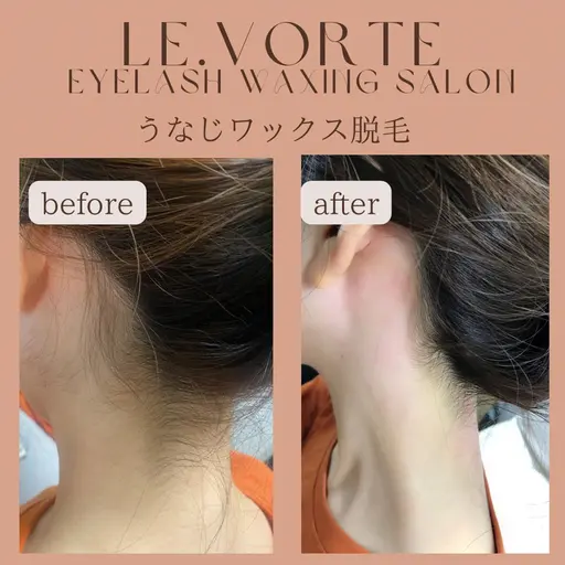 成人式にピッタリ！🩵うなじワックス脱毛🩵保湿パック付き🩵