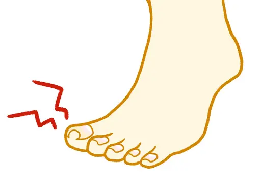 巻き爪補正