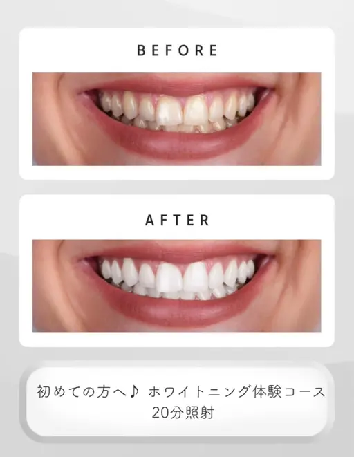 【歯を白くしたい方】医療ホワイトニング✨18000→条件付き1980円or8800円→1980円で受けられる！