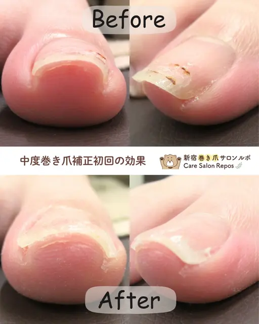 5月末まで！モニター様価格【巻き爪補正　1箇所　5,500円→2,200円】