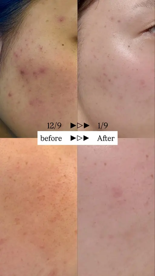 初回限定‼️  女性限定‼️　カウンセリング➕超音波フェイシャルエステ