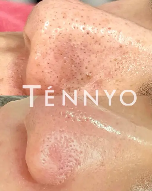 ミニモ限定！毛穴洗浄。専用美容液で優しく古い角質/角栓/皮脂などの汚れを取り除きます。化粧ノリ◎スキンケア浸透も◎