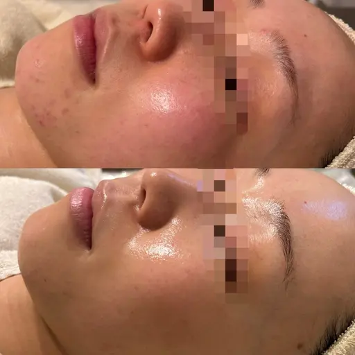 【小顔・肌荒れ】オールハンド美肌スペシャルケア