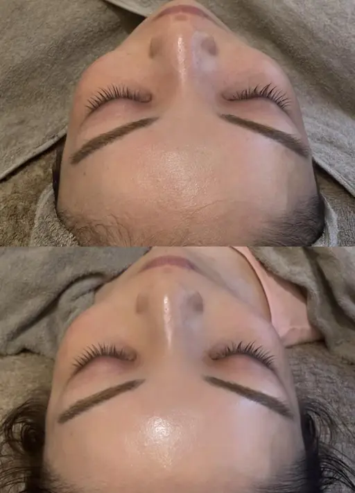 人気No2✨【黒ずみ.毛穴詰まり👃スッキリ】毛穴洗浄🌪️＋電気美容鍼⭐️エレクトロポレーション導入付き学割◎