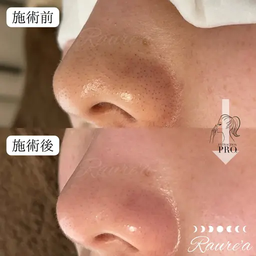【毛穴美人コース】