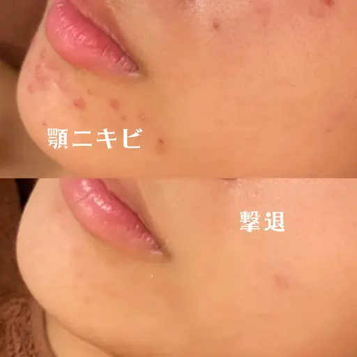 【14日限定💫❕】ピーリング&自律神経調節ヘッドマッサージ🌿