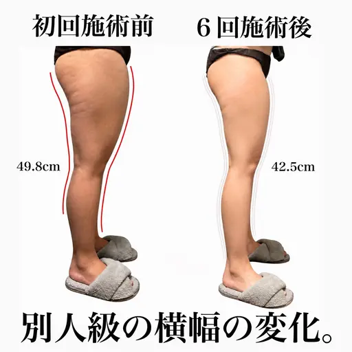 🏖️夏直前‼︎本気の脚やせ痩身『5回チケット』