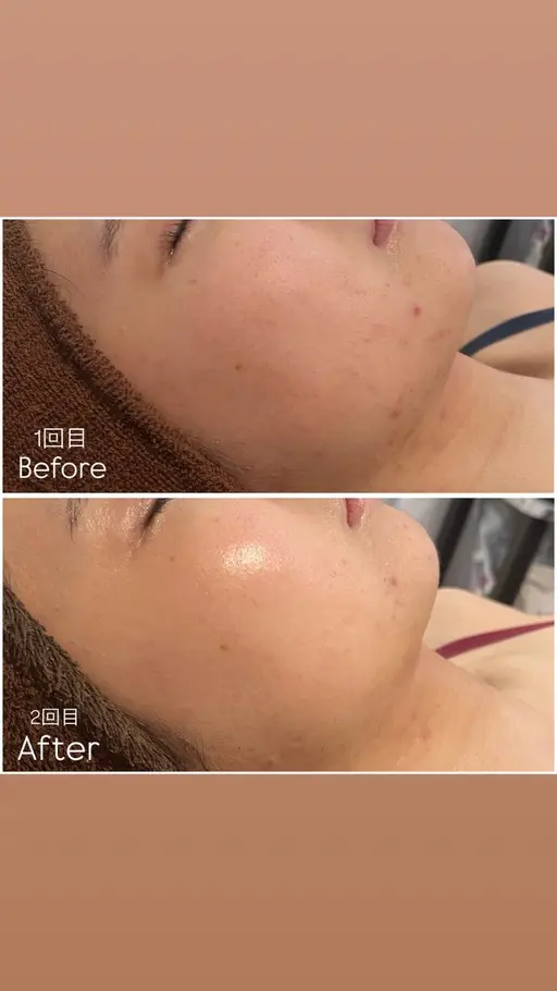 REVIハーブピーリング🌿【スペシャルケア】