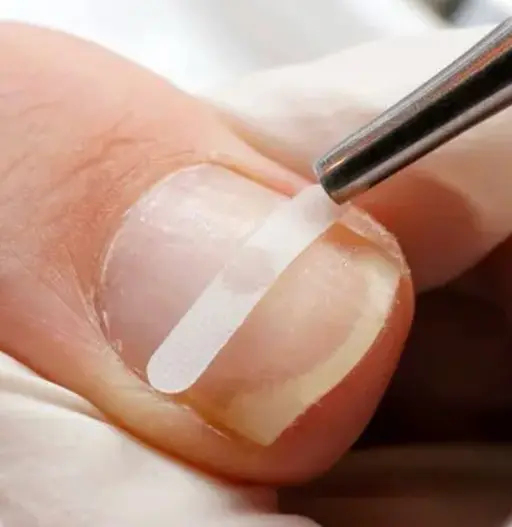 【急募！】巻き爪補正👣1本5500円→1,100円✨