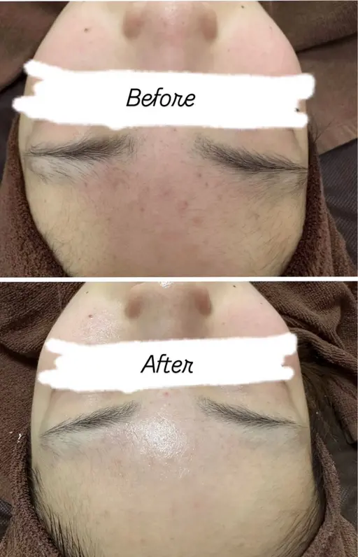 ニキビ肌最新のピーリングで韓国肌へ症例取らせてください‼️