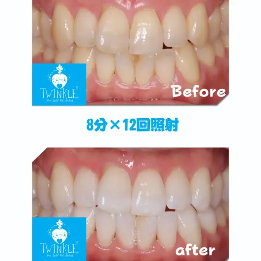 ✨当店人気NO１メニュー✨これで真っ白❣️お出かけや旅行大事なご予定前に！１２回照射×８分