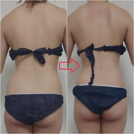 🉐【痩身人気No.1】今すぐ痩せたい!綺麗になりたい方✨ハイパーナイフ痩身100分×3回※条件アリ