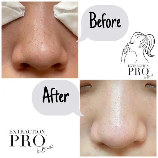 SNSで話題の毛穴エクストラクションプロ‼︎初回特別割引♪いちご鼻撃退！長年の毛穴のお悩み改善★