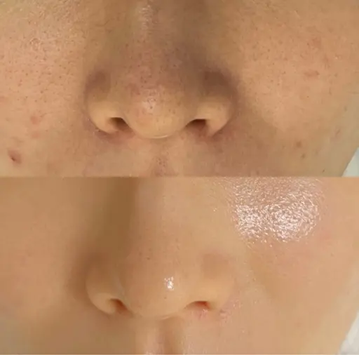 𝐍𝐨. 𝟏🎀モデル限定🌟 韓国🇰🇷で大人気✨【水光艶肌セラピール＋セラパック】美白・毛穴・肌質改善