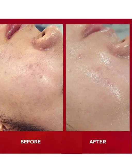 韓国白玉ピーリング