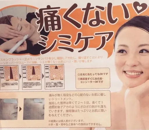 💫人気NO1💫痛くないシミ取り🪄しっかり20ショット