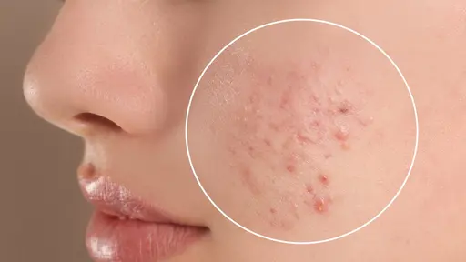 美肌改善モニターメニュー✨️