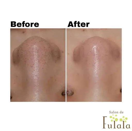 【4/14限定✨ご新規様限定】毛穴の角栓ごっそりモニター¥11,000→¥2,200