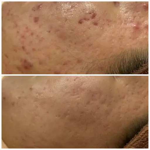 📍平日10-15時限定📍しつこいニキビ/繰り返すニキビ痕/毛穴/黒ずみ/天然温泉HOTパックつき♨️✨