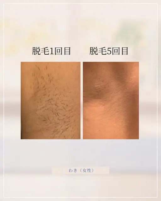 【U25女性限定】剃る生活辞めたい方へ✨全身脱毛（顔or VIO）（先着5名様）