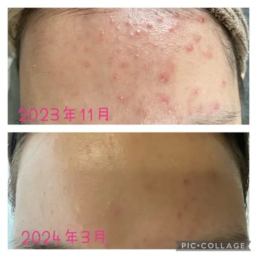 人気No.1🌿毛穴・ニキビケアフェイシャル 2回コース