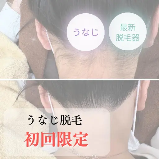 GWまだ間に合います!🩵うなじ「デザインシェービング込み」脱毛 ¥4400円→¥3300円
