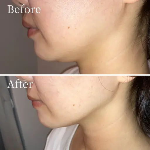 【スッキリ理想の小顔へ☆】小顔脂肪ぶんかいコース