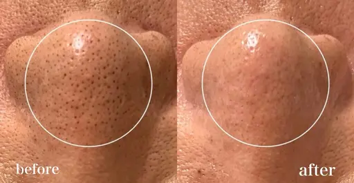 \いちご鼻解消/毛穴洗浄💧