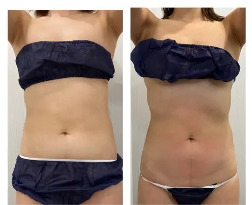 ミニモ限定【お腹痩せ】ダイエットマシンで頑固な下腹部/燃焼！まで燃1回でも効果有!