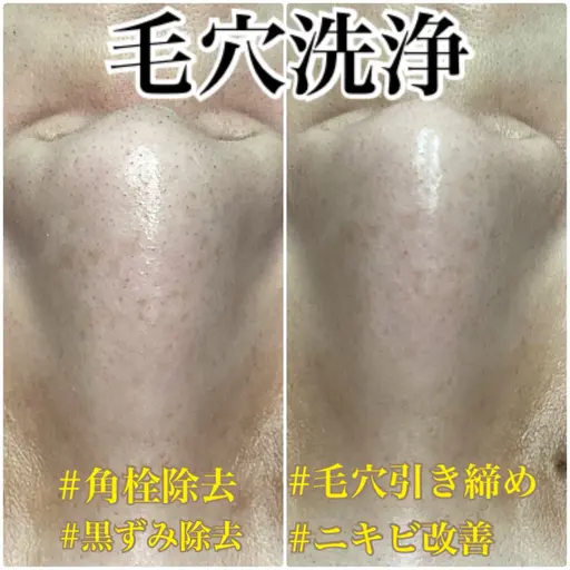 毛穴洗浄コース