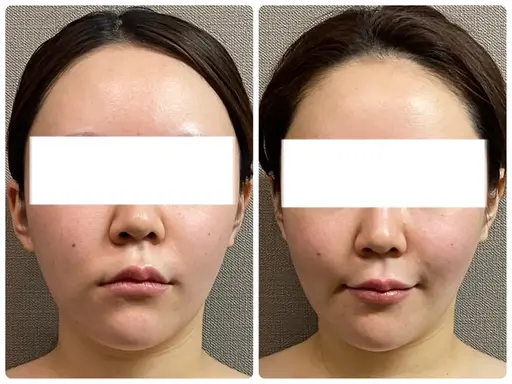 通常価格【ほうれい線・ゴルゴライン・マリオネット】改善凝り固まったエラ頬を撃退☆80min【¥16500→¥8800】