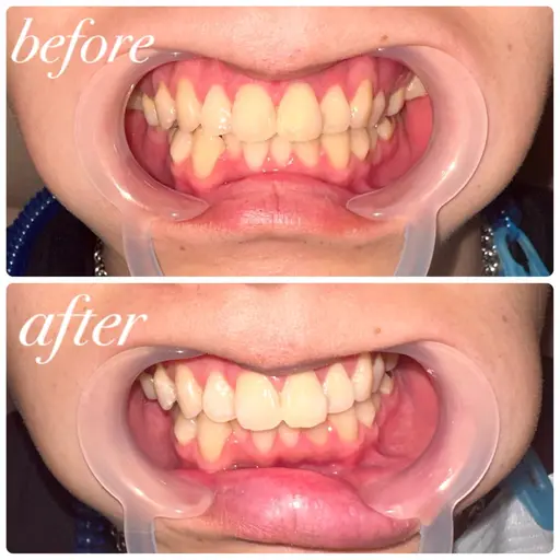 【8回券🎫】驚きのトーンアップ！全16回照射(1セット10分✖️2照射8回分)🦷ハイパワーセルフホワイトニング✨