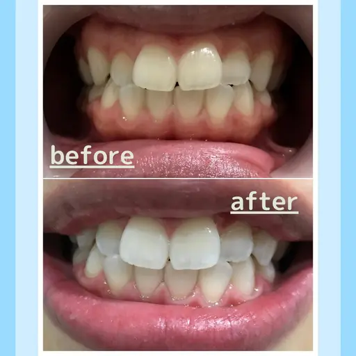 【【超破格!!】】🌟minimo限定🌟セルフホワイトニング初回お試し¥2000 平均4トーンアップ💎