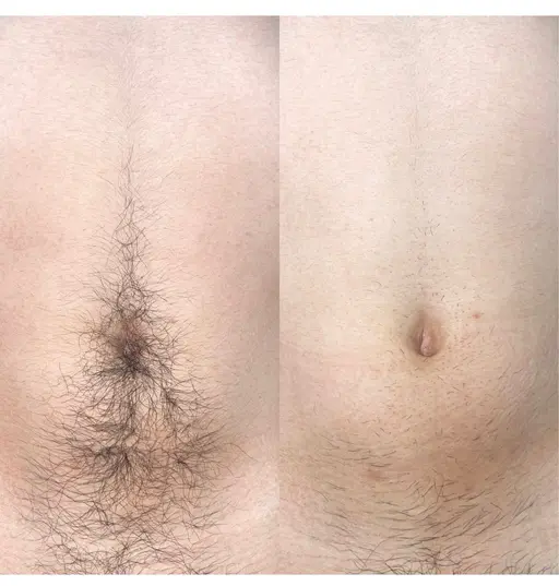 激安価格!きちんと抜ける!女性全身脱毛vio顔込み