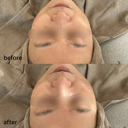 ハーバルフルーツピーリング ✩.*˚ ハリ、ツヤ激変!肌質改善